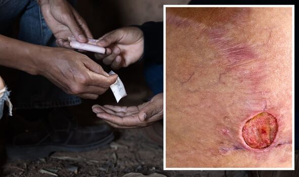 New Skin Rotting Drug Is Literally Turning Drug Users Into Zombies